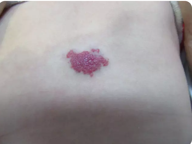 小孩手臂上的血管瘤治疗后恢复时间