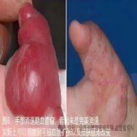 专家科普：血管瘤能否自然消退呢！