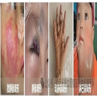 脉管畸形严重吗？有什么特征呢？