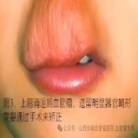 专家科普：血管瘤能否自然消退呢！