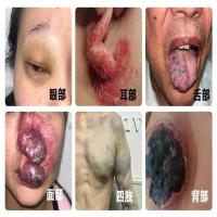 宝宝有血管瘤，你需要知道这些
