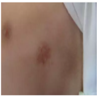 左腋下血管瘤康复