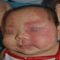 山西省儿童医院皮肤科李垣君主任为您解决红胎记的困扰