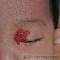 专家科普：对待血管瘤千万别“佛系”，盲目等待不可取