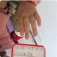 左手部血管瘤患儿康复