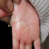 1个月大娃娃手心长了血管瘤，可急坏了全家