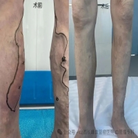 静脉曲张：该治疗吗？最佳治疗期是哪个阶段呢?