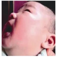 宝宝脸部混合型血管瘤康复