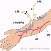 医生搭“桥”：重建血液透析患者的生命线