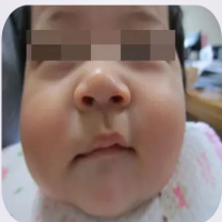 鼻部混合型血管瘤患儿康复