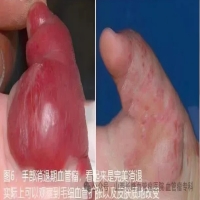 专家科普：血管瘤能否自然消退呢！