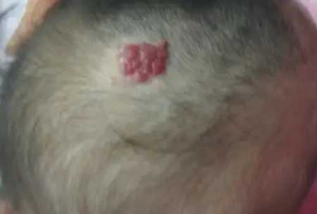 头部血管瘤12_566 头部血管瘤12_566
