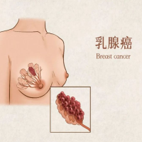 远离乳腺癌 从生活方式开始守护自己
