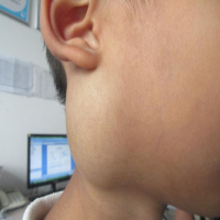 什么是深部血管瘤