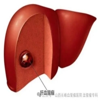 肝脏血管瘤外科治疗专家共识