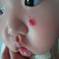 专家带您了解血管瘤问题