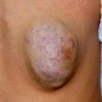 宝宝长血管瘤会自己消失吗？