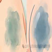 常见的胎记都有哪些？