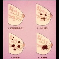 乳腺有病是不是就和心情有关系