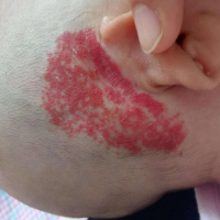 表浅血管瘤和深部血管瘤的区别