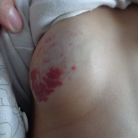 特别关注：细心妈妈请关注一下婴幼儿胎记