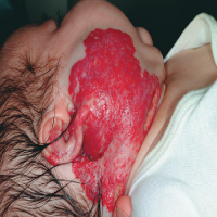 小儿血管瘤 到底怎么治？