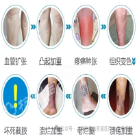静脉曲张可以不管吗