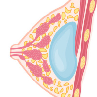 乳腺纤维腺瘤，到底会不会癌变？