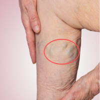 静脉曲张，要如何治疗