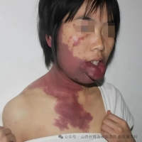 山西省儿童医院皮肤科李垣君主任为您解决红胎记的困扰